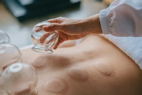 Dry cupping behandeling bij ZorgWereld fysiotherapie