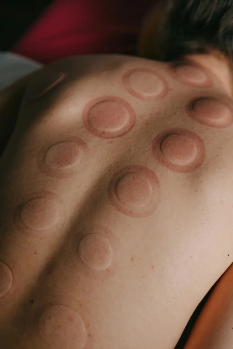 Dry cupping behandeling bij ZorgWereld fysiotherapie